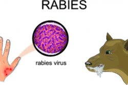 Симптомы бешенства у человека