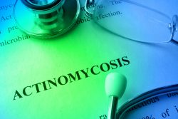 Актиномикоз челюстно-лицевой области: почему возникает и как лечить