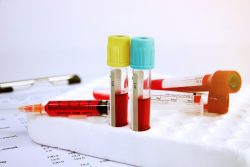 Макроглобулинемия Вальденстрема: проявления, лечение