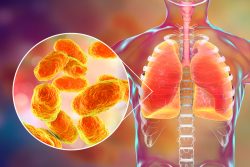 Гемофильная инфекция: что ее вызывает, как проявляется, прививка