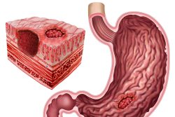 Каллезная язва желудка: чем опасна, как от нее избавиться