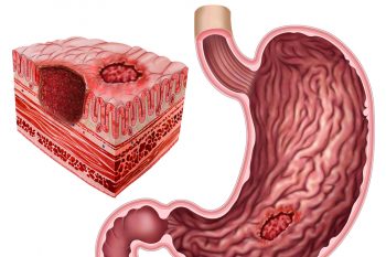 Каллезная язва желудка: чем опасна, как от нее избавиться