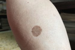 Диабетическая дермопатия и другие виды поражения кожи при диабете