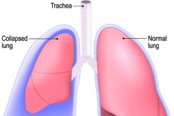 Ателектаз легкого: виды, причины, симптомы, лечение