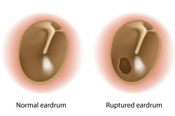 Разрыв барабанной перепонки: симптомы, как лечить