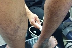 Ультразвуковая допплерография сосудов нижних конечностей: показания и противопоказания