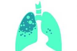 Казеозная пневмония при туберкулезе: особенности течения, принципы лечения, прогноз