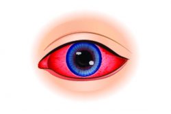 Туберкулез глаз: симптомы, диагностика, лечение