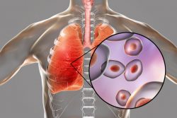 Пневмоцистная пневмония у ВИЧ-инфицированных: особенности течения и лечения