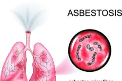 Асбестоз: причины, признаки, лечение