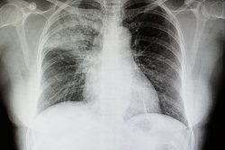 Инфильтрация легких: что это такое, при каких заболеваниях встречается