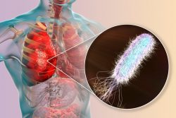 Внутрибольничная пневмония: возбудители, особенности течения и лечения