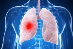 Туберкулома легких: что это, последствия