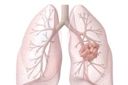 Саркома легкого: особенности течения, современные методы лечения