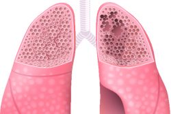 Синдром Маклеода: чем проявляется и как лечить