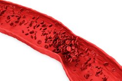 Безболевая ишемия миокарда: диагностика, лечение