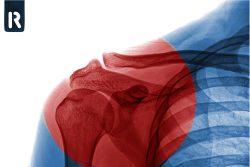 Плечелопаточный периартрит: симптомы и лечение