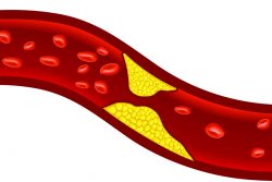 Атеросклероз сосудов сердца: симптомы и лечение