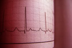 Синдром удлиненного интервала qt: почему возникает, чем проявляется, как лечить
