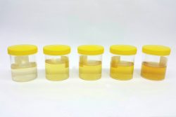 Почему изменяется цвет мочи