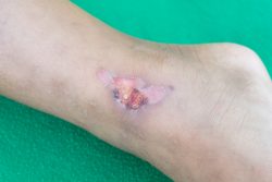 Гангренозная пиодермия: особенности течения, лечение