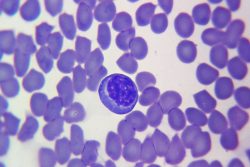 Синдром Сезари: характерные симптомы, принципы лечения