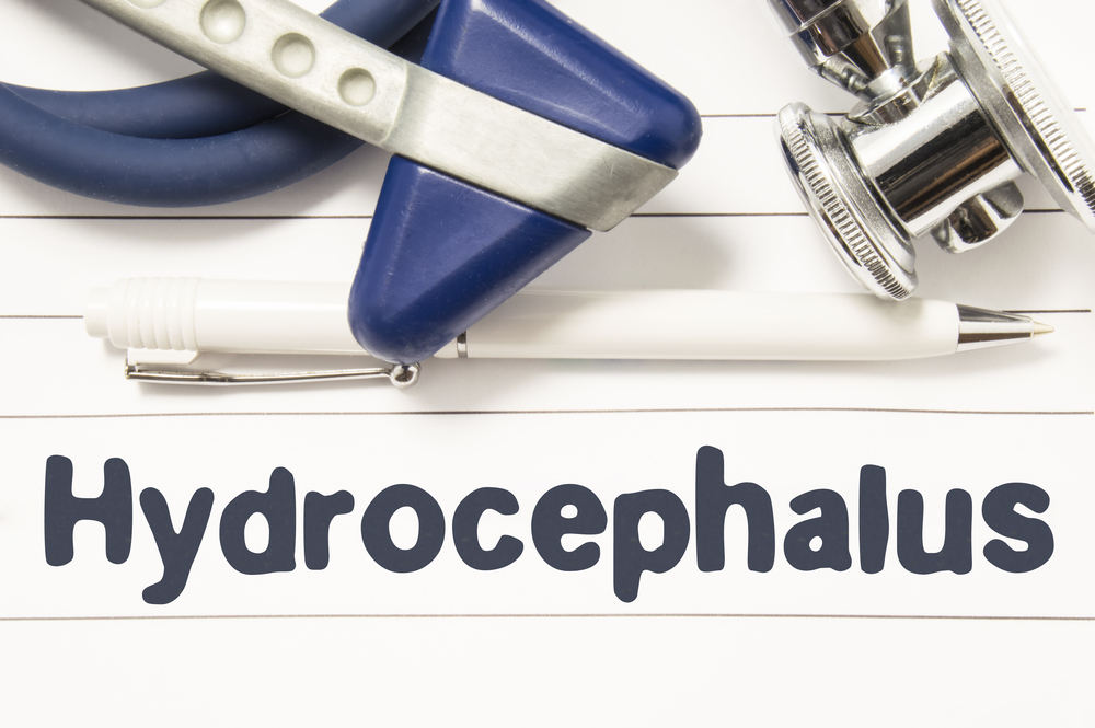 Гидроцефалия головного мозга у взрослых: причины, симптомы, лечение