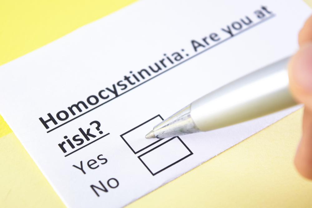 Гомоцистинурия: симптомы и лечение