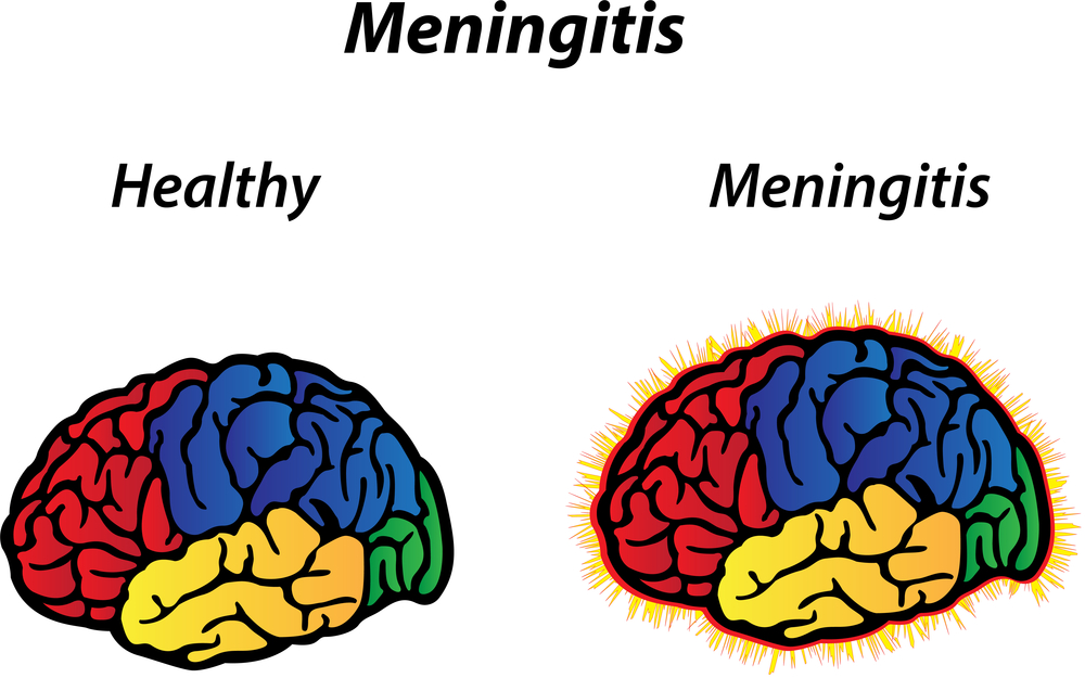 Гнойный менингит: первые признаки, диагностика и лечение