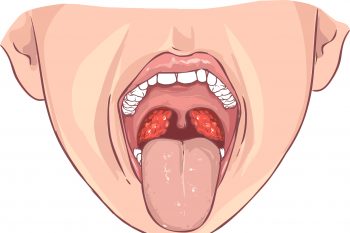 Как вылечить хронический тонзиллит
