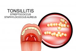Как лечить гнойную ангину