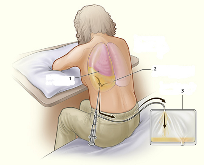 плевральная пункция_поза