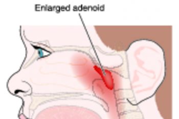 Аденоидит у детей: симптомы и лечение