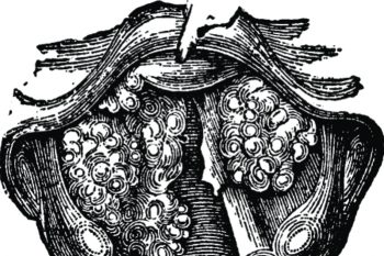 Папилломатоз гортани: виды, симптомы, современные методы лечения