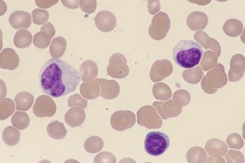 Моноцитарная ангина: особенности течения