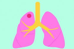 Абсцесс легкого: симптомы, лечение