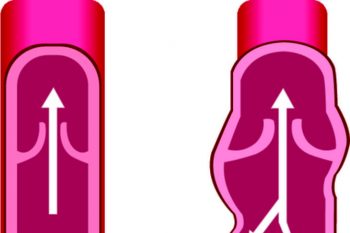 Why is phlebectomy outdated as a method of vein removal?